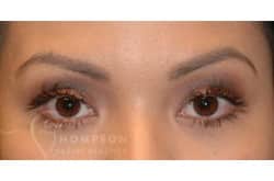 After Image: Upper Blepharoplasty by Dr. Thompson - front