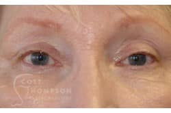 After Image: Upper Blepharoplasty by Dr. Thompson - front