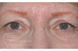 Before Image: Upper Blepharoplasty by Dr. Thompson - front