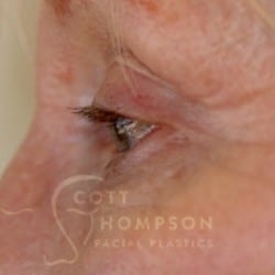 After Image: Upper Blepharoplasty by Dr. Thompson - left-side