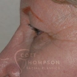 Before Image: Upper Blepharoplasty by Dr. Thompson - left-side