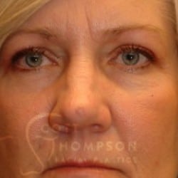 After Image: Upper Blepharoplasty by Dr. Thompson - front