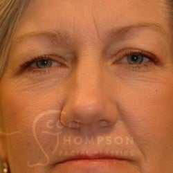 Before Image: Upper Blepharoplasty by Dr. Thompson - front