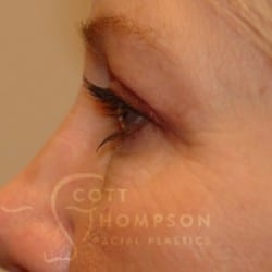 After Image: Upper Blepharoplasty by Dr. Thompson - left-side