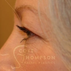 Before Image: Upper Blepharoplasty by Dr. Thompson - left-side