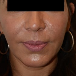 After Image: Chin Implant and Submental Liposuction by Dr. Thompson - front