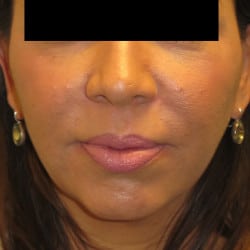 Before Image: Chin Implant and Submental Liposuction by Dr. Thompson - front