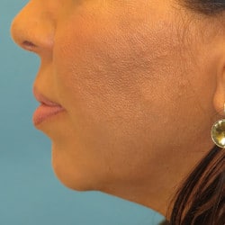 Before Image: Chin Implant and Submental Liposuction by Dr. Thompson - left-side