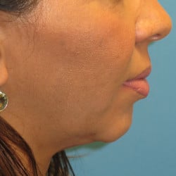 Before Image: Chin Implant and Submental Liposuction by Dr. Thompson - right-side