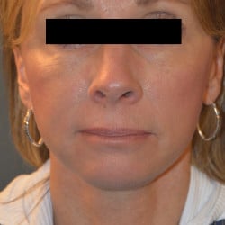 After Image: Facelift and Perioral Dermbrasion by Dr. Thompson - front