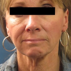 Before Image: Facelift and Perioral Dermbrasion by Dr. Thompson - front