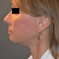 After Image: Facelift and Perioral Dermbrasion by Dr. Thompson - left-side