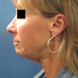 Before Image: Facelift and Perioral Dermbrasion by Dr. Thompson - left-side