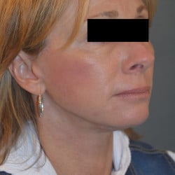 After Image: Facelift and Perioral Dermbrasion by Dr. Thompson - right-front-oblique
