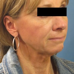 Before Image: Facelift and Perioral Dermbrasion by Dr. Thompson - right-front-oblique