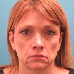 Before Image: Macslift, Fat Injections, Lower Eyelids, and Septoplasty by Dr. Thompson