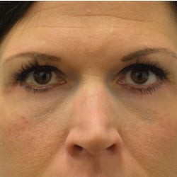 After Image: Lower Blepharoplasty by Dr. Henstrom - front