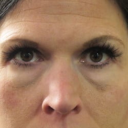 Before Image: Lower Blepharoplasty by Dr. Henstrom - front