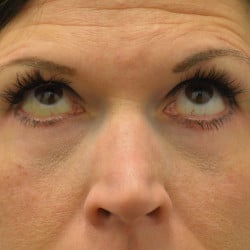 After Image: Lower Blepharoplasty by Dr. Henstrom - front