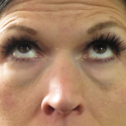 Before Image: Lower Blepharoplasty by Dr. Henstrom - front