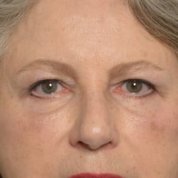 After Image: Upper & Lower Blepharoplasty by Dr. Thompson - front