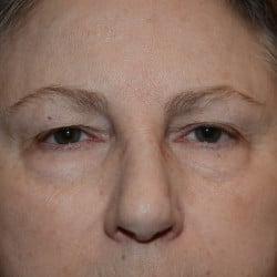 Before Image: Upper & Lower Blepharoplasty by Dr. Thompson - front