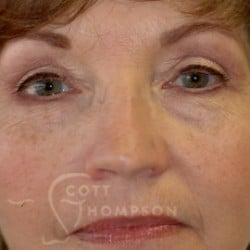 After Image: Upper Blepharoplasty by Dr. Thompson - front