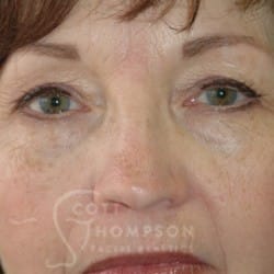 Before Image: Upper Blepharoplasty by Dr. Thompson - front