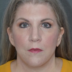 After Image: Facelift & Browlift by Dr. Thompson - front