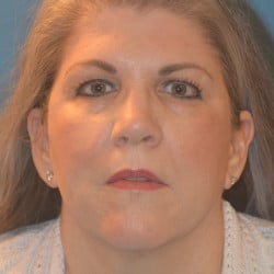 Before Image: Facelift & Browlift by Dr. Thompson - front