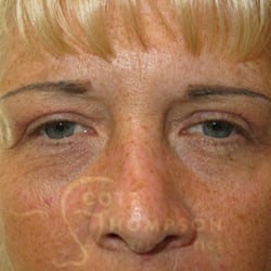 After Image: Upper Blepharoplasty by Dr. Thompson - front