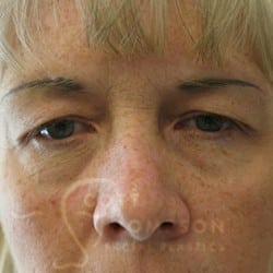 Before Image: Upper Blepharoplasty by Dr. Thompson - front