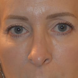 After Image: Upper Blepharoplasty, Lower Lid Skin Pinch, & Periorbital Fat Injections by Dr. Thompson - front