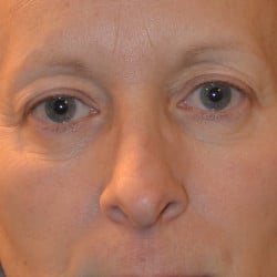 Before Image: Upper Blepharoplasty, Lower Lid Skin Pinch, & Periorbital Fat Injections by Dr. Thompson - front
