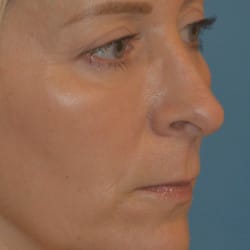 After Image: Upper Blepharoplasty, Lower Lid Skin Pinch, & Periorbital Fat Injections by Dr. Thompson - right-front-oblique