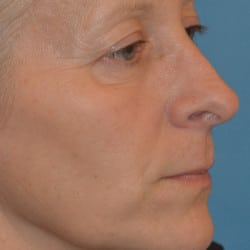 Before Image: Upper Blepharoplasty, Lower Lid Skin Pinch, & Periorbital Fat Injections by Dr. Thompson - right-front-oblique
