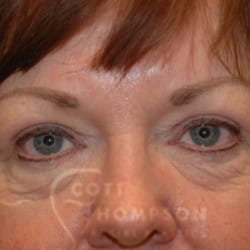 After Image: Upper Blepharoplasty Patient by Dr. Thompson - front