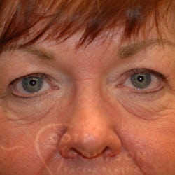 Before Image: Upper Blepharoplasty Patient by Dr. Thompson - front