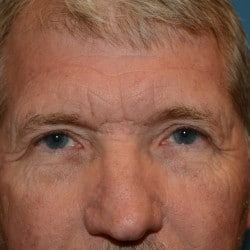 After Image: Direct Browlift and Upper Blepharoplasty  by Dr. Thompson - front