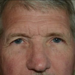 Before Image: Direct Browlift and Upper Blepharoplasty  by Dr. Thompson - front