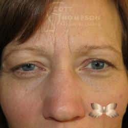 Before Image: Upper Eyelid Lift – 328 - front