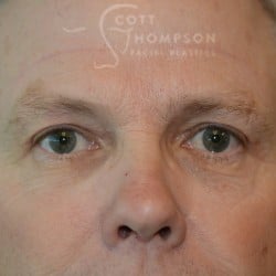 After Image: Upper Eyelid Surgery | Utah Facial Plastics – 432 - front