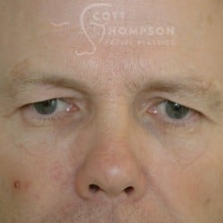 Before Image: Upper Eyelid Surgery | Utah Facial Plastics – 432 - front