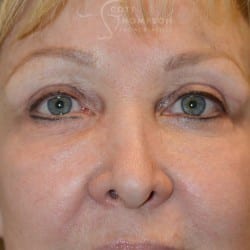 After Image: Upper Eyelid Lift | Lower Eyelid Lift with Fat Repositioning – 745 - front