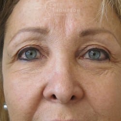 Before Image: Upper Eyelid Lift | Lower Eyelid Lift with Fat Repositioning – 745 - front