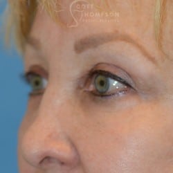 After Image: Upper Eyelid Lift | Lower Eyelid Lift with Fat Repositioning – 745 - left-front-oblique