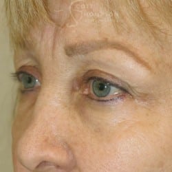 Before Image: Upper Eyelid Lift | Lower Eyelid Lift with Fat Repositioning – 745 - left-front-oblique