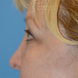 After Image: Upper Eyelid Lift | Lower Eyelid Lift with Fat Repositioning – 745 - left-side