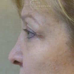 Before Image: Upper Eyelid Lift | Lower Eyelid Lift with Fat Repositioning – 745 - left-side