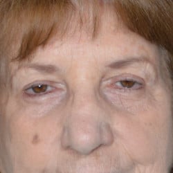 After Image: Upper Blepharoplasty by Dr. Thompson - front